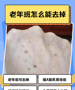 身上长寿斑怎么办