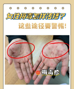 五色梅毒怎么解