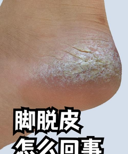 帝玉什么情况叫脱皮