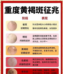 冬天脸上起黑斑怎么办