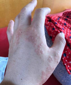 养花手上红疹