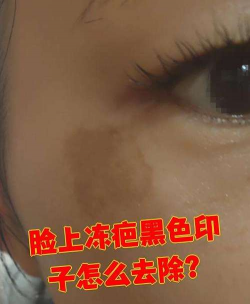 脸上冻伤褐色印记怎么办