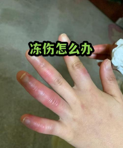 蓝花茄冻伤怎么办