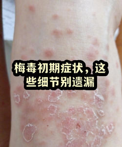 榉树长斑枯死病,防治方法要记牢,关键细节别忽略 榉树长斑枯死病,防治方法要记牢,关键细节别忽略