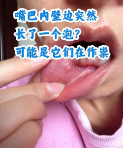 马水泡性口炎 马水泡性口炎